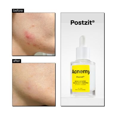 Acnemy Postzit Post-Pimple Marks Corrector Serum (Сироватка для боротьби з акне), 30 мл 8436585432011 фото