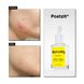 Acnemy Postzit Post-Pimple Marks Corrector Serum (Сироватка для боротьби з акне), 30 мл 8436585432011 фото 2